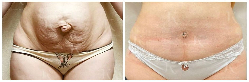 Фото до и после абдоминопластики у пластического хирурга Косинца Владимира Александровича