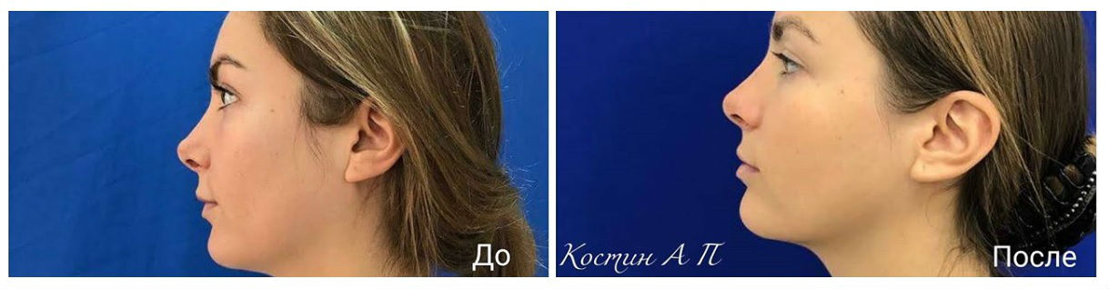 Фото до и после операции ринопластики у пластического хирурга Костина Александра Павловича