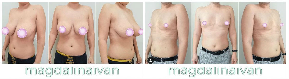 Фото до и после операции коррекции груди у пластического хирурга Магдалина Ивана Петровича