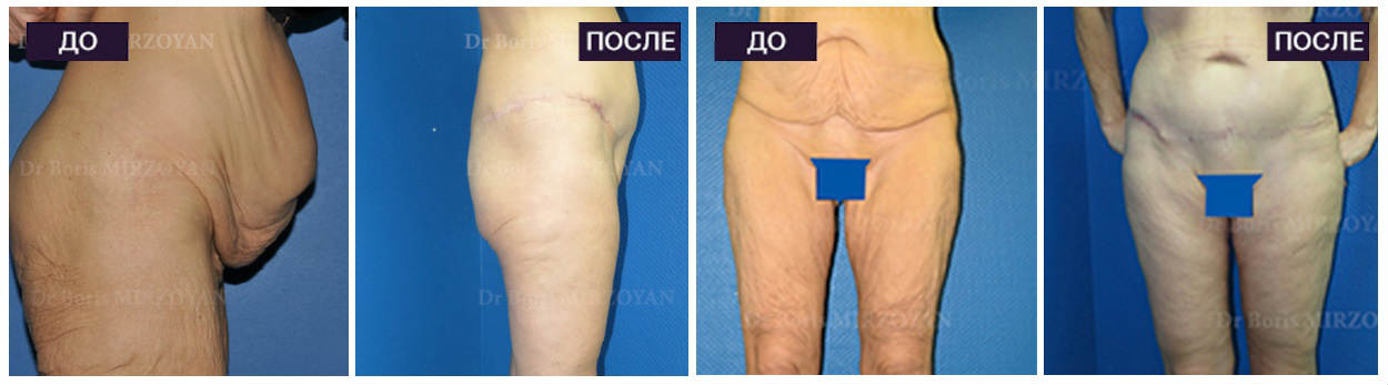 Фото до и после абдоминопластики у пластического хирурга Азизяна Ваагна Самвеловича