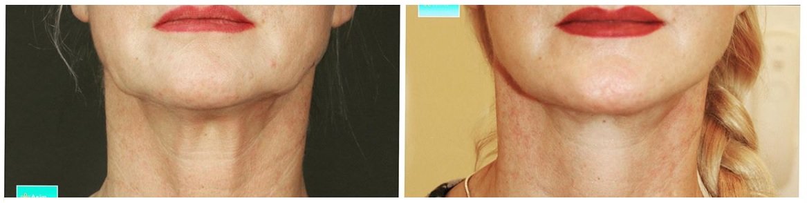 Фото до и после операции подтяжки лица у пластического хирурга Никешина Акима Иосифовича