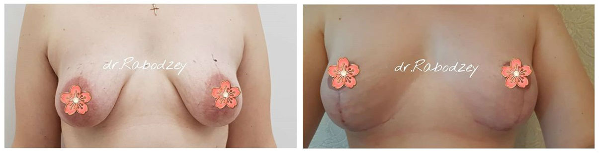 Фото до и после операции коррекции груди у пластического хирурга Рабодзей Ольги Павловны
