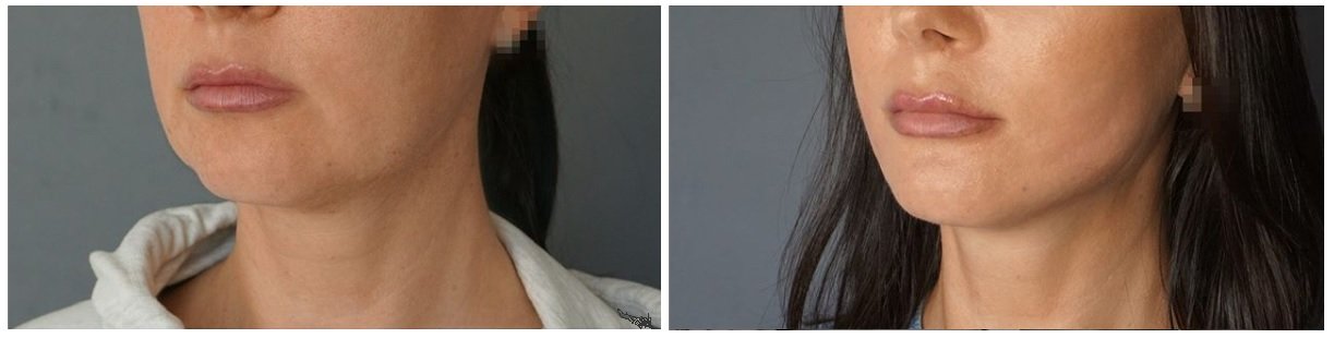 Фото до и после операции у пластического хирурга Шемонаевой Ольги Михайловны
