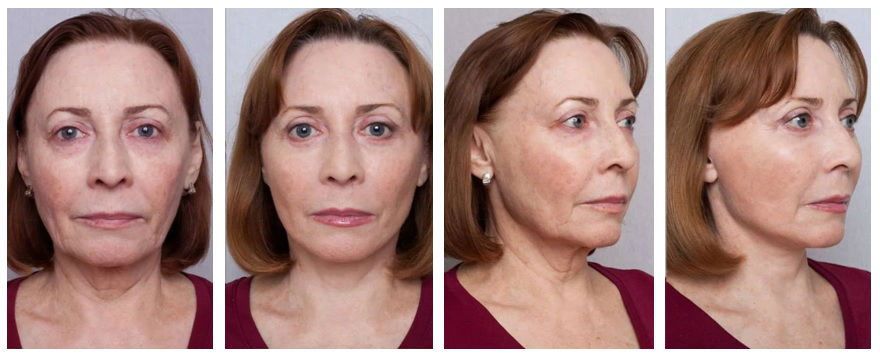 Фото до и после операции на лице у пластического хирурга Шихирмана Эдуарда Вадимовича