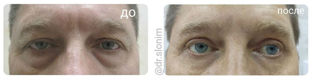Фото до и после блефаропластики у пластического хирурга Слонима Анатолия Александровича