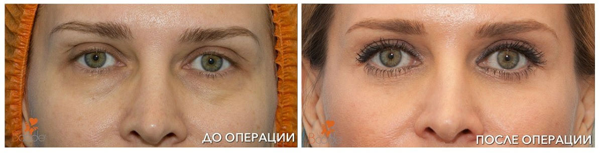 Фото до и после ринопластики у пластического хирурга Валиева Умида Джасурбековича