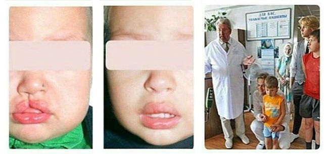 Фото до и после пластической операции у пластического хирурга Виссарионова Владимира Алексеевича