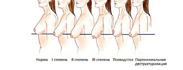 Цены на подтяжку грудных желез в Москве