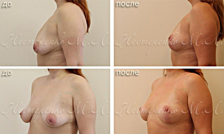 Фотографии до и после операции по подтяжке груди