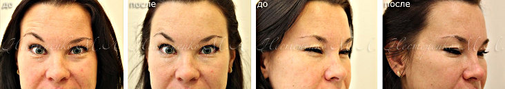 Фотографии до и после омоложения кожи введением ботокса