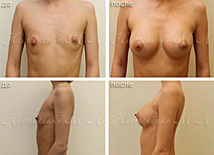 Фото до и после операции по увеличению груди