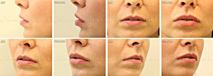 Фотографии до и после увеличения тонких губ