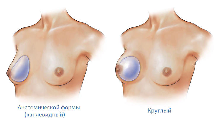 Выбор имплантата для пластической операции по увеличению груди