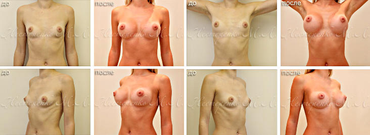 Фотографии до и после маммопластики анатомическими грудными имплантами