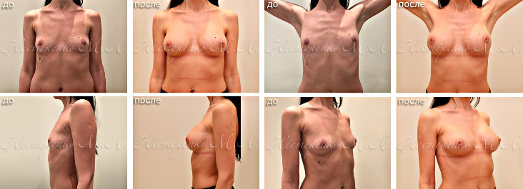 Евросиликон - фотографии до и после установки имплантов груди