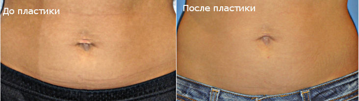 Фотографии до и после умбиликопластики (коррекции формы пупка)