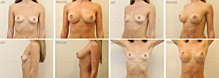 Фотографии до и после увеличения груди круглыми имплантами