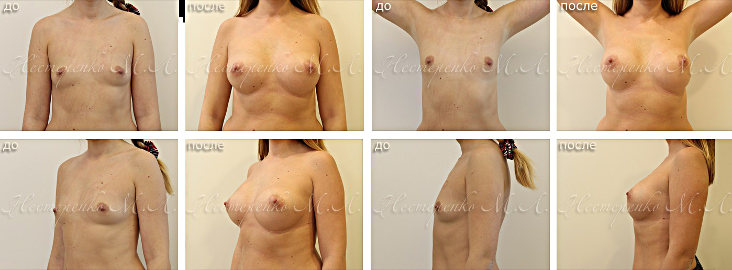 Motiva - фотографии до и после установки имплантов груди