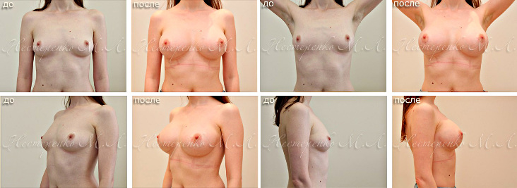 Фотографии до и после установки грудных имплантов Натрель (МакГан) от Аллерган