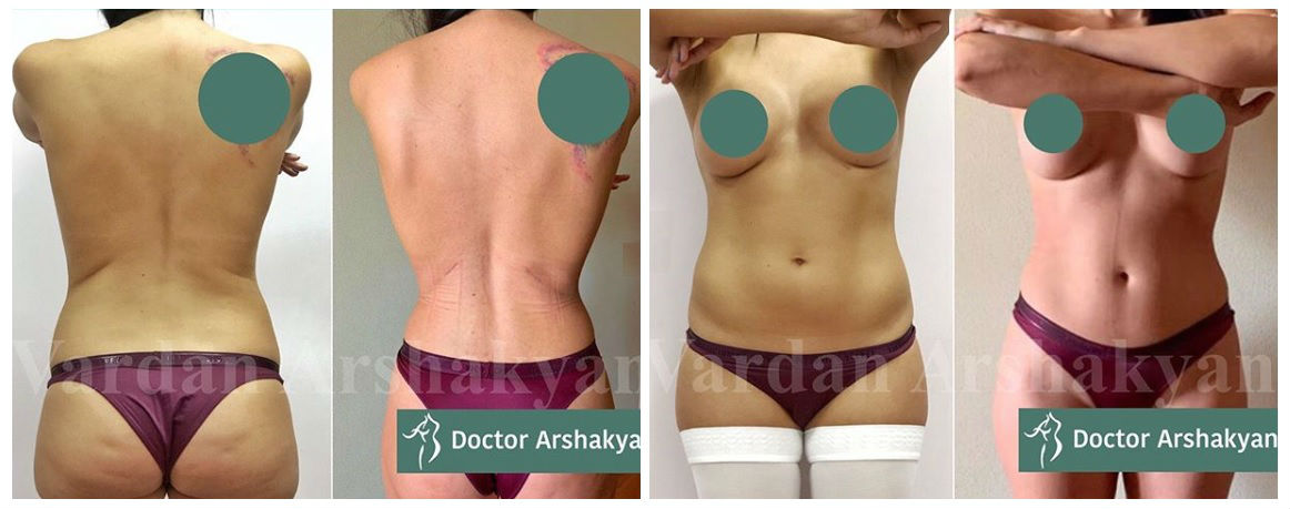 Фото до и после операции у пластического хирурга Аршакяна Вардана Арамаисовича