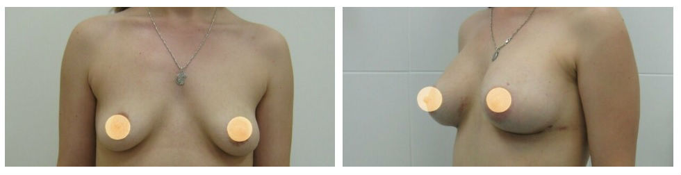 Фото до и после операции пластики груди у пластического хирурга Баулина Владимира Викторовича