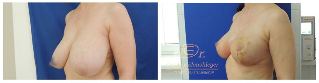Фото до и после операции по увеличению груди у пластического хирурга Эленшлегера Дмитрия Владимировича