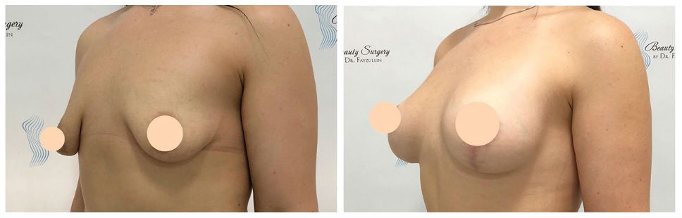 Фото до и после операции по увеличению груди у пластического хирурга Файзуллина Тагира Ришатовича