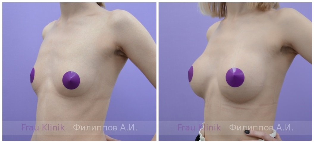 Фото до и после пластики груди у пластического хирурга Филиппова Александра Игоревича