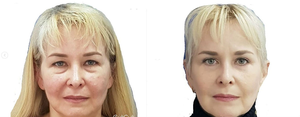 Фото до и после операции пластики век у пластического хирурга Гоглова Матвея Олеговича