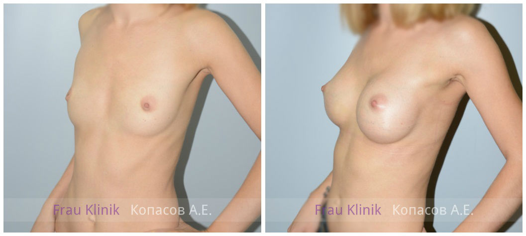 Фото до и после пластики груди у пластического хирурга Копасова Андрея Евгеньевича