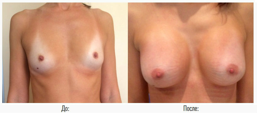 Фото до и после операции пластики груди у пластического хирурга Крысина Дмитрия Викторовича