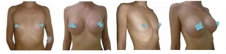 Фото до и после операции пластики груди у пластического хирурга Лобачёва Кирилла Сергеевича