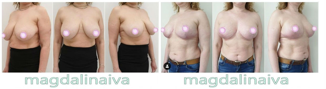 Фото до и после операции по увеличению груди у пластического хирурга Магдалина Ивана Петровича