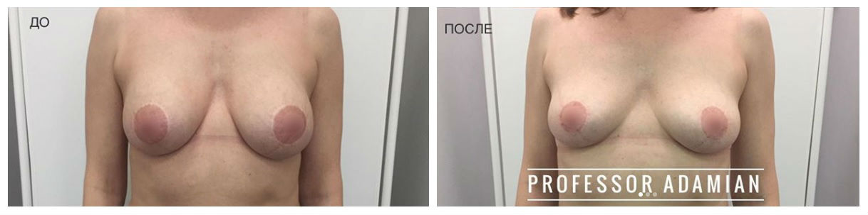 Фото до и после пластики груди у пластического хирурга Адамяна Рубена Татевосовича