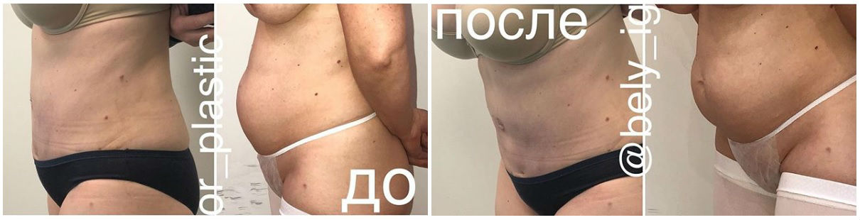 Фото до и после пластики у пластического хирурга Белого Игоря Анатольевича