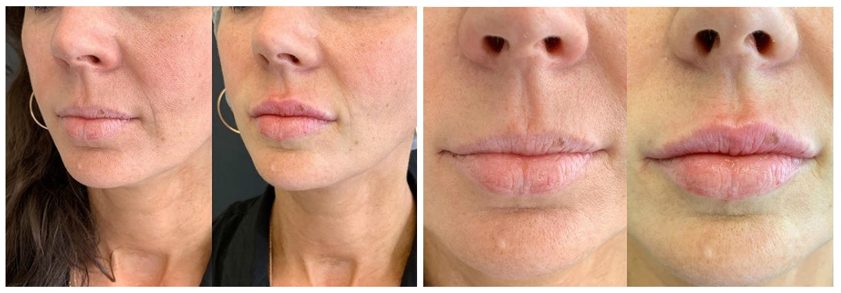 Фото до и после пластики губ у пластического хирурга Чирковой Анастасии Викторовны