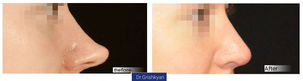 Фото до и после пластики носа у пластического хирурга Гришкяна Давида Рубеновича