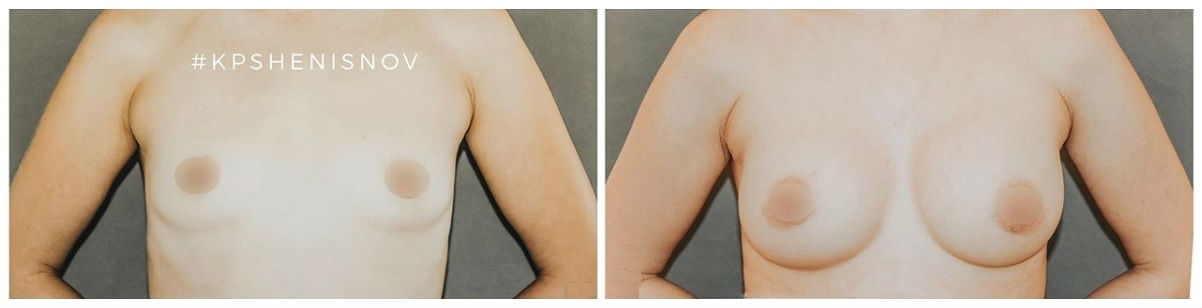 Фото до и после маммопластики у пластического хирурга Пшениснова Кирилла Павловича