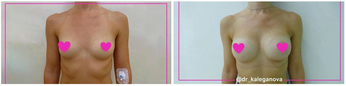 Фото до и после пластики груди у пластического хирурга Калегановой Анны Юрьевны