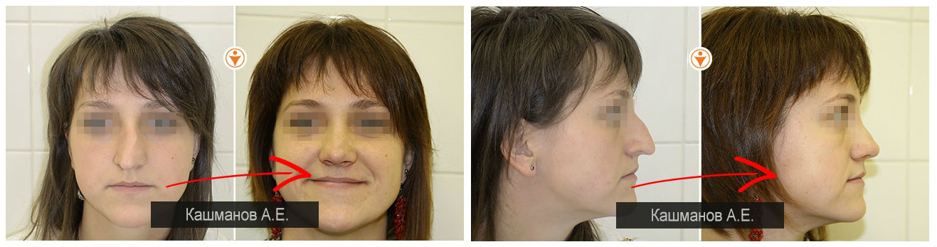 Фото до и после пластики носа у пластического хирурга Кашманова Андрея Евгеньевича