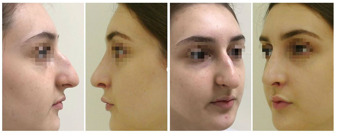 Фото до и после пластики носа у пластического хирурга Константинова Бадри Гулиевича