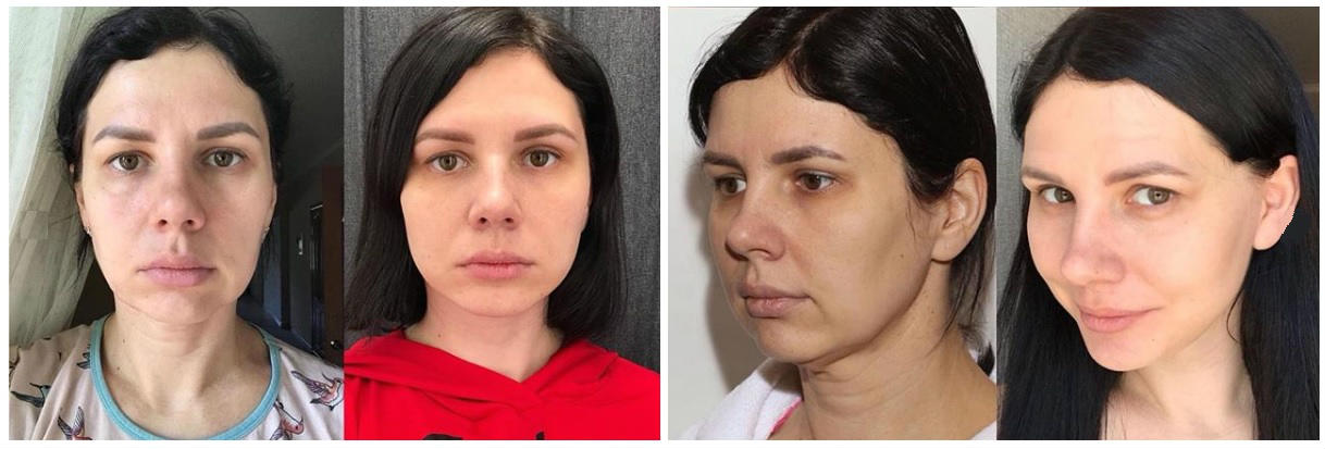 Фото до и после пластики лица у пластического хирурга Коробкова Георгия Игоревича