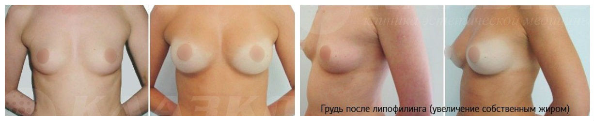 Фото до и после абдоминопластики у пластического хирурга Котелевица Алексея Геннадьевича