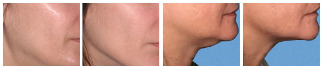 Фото до и после лечения в клинике Лантан