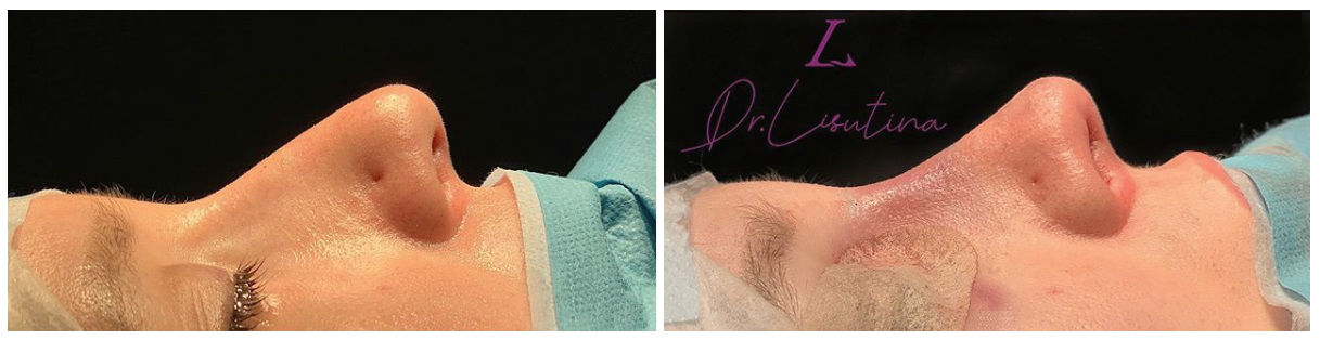 Фото до и после ринопластики у пластического хирурга Лисутиной Марии Николаевны