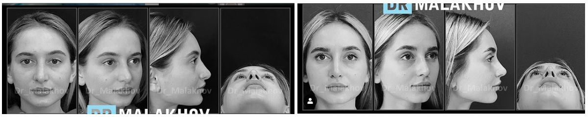 Фото до и после ринопластики у пластического хирурга Малахова Александра Андреевича