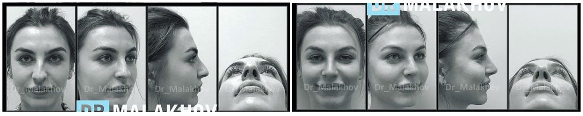 Фото до и после ринопластики у пластического хирурга Малахова Александра Андреевича