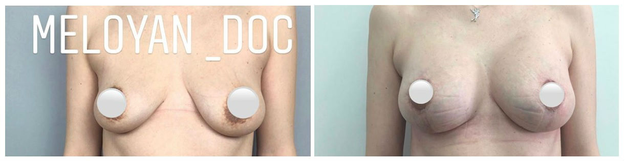 Фото до и после пластики груди у пластического хирурга Мелояна Мхитара Мисаковича