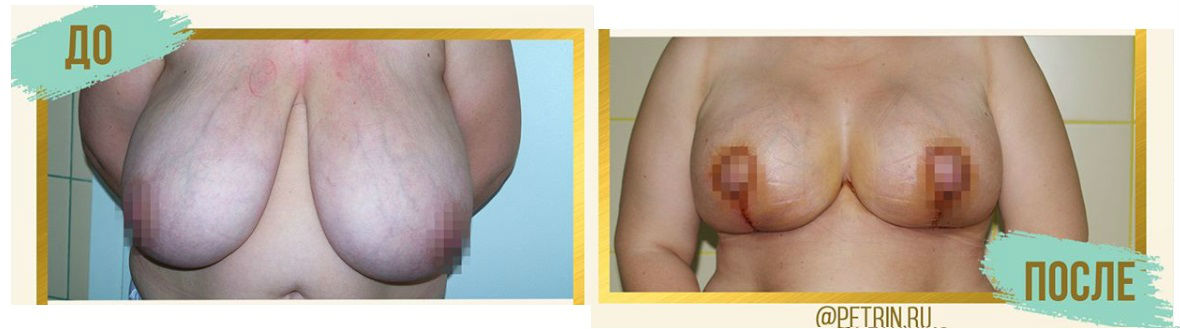 Фото до и после маммопластики у пластического хирурга Петрина Сергея Александровича