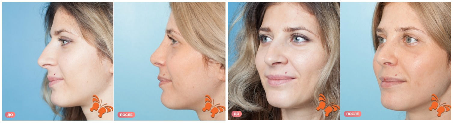 Фото до и после пластики носа у пластического хирурга Пуцилло Сергея Павловича